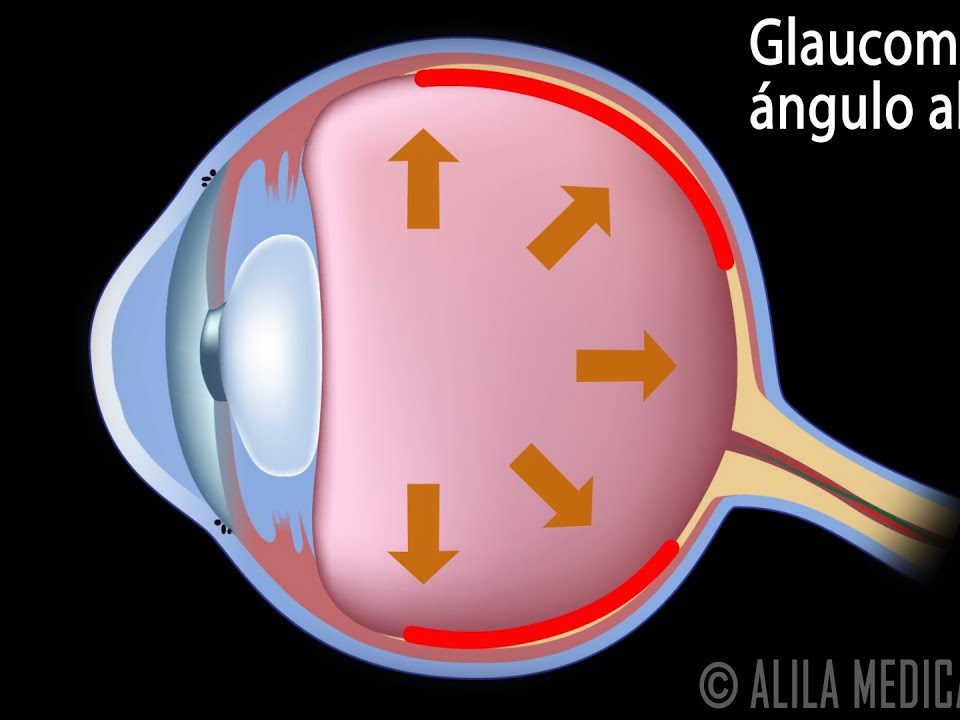 Glaucoma Primario de Angulo Abierto - Dr. Jose Marcial Baya Terceros - Oftalmólogo - La Paz